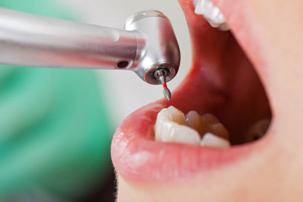 Best Emergency Wisdom Teeth Removal in Hilltop, MN